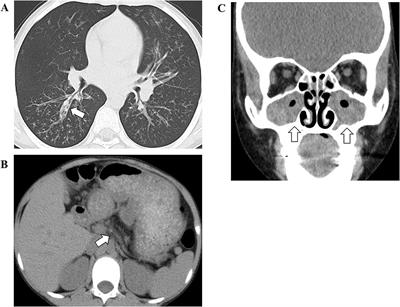 Case Report: Japanese Siblings of Cystic Fibrosis With a Novel Large Heterozygous Deletion in the CFTR Gene